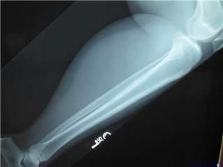 Leg X ray Knee to Ankle Radiology Anatomy Image  